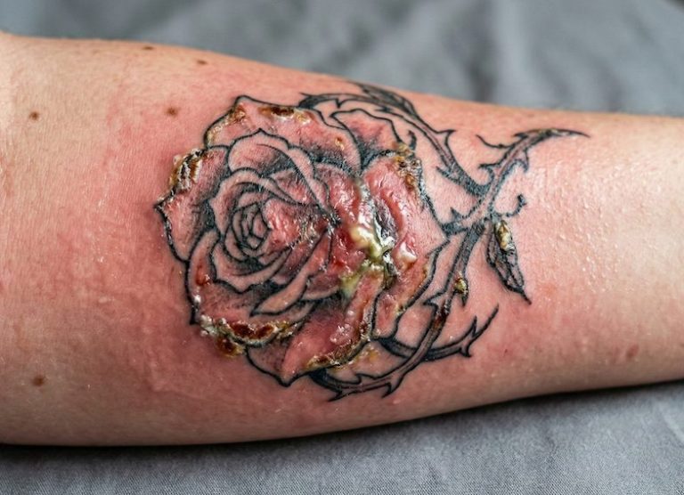 Tulehtunut tatuointi: Mitä tehdä ja miten tunnistaa oireet